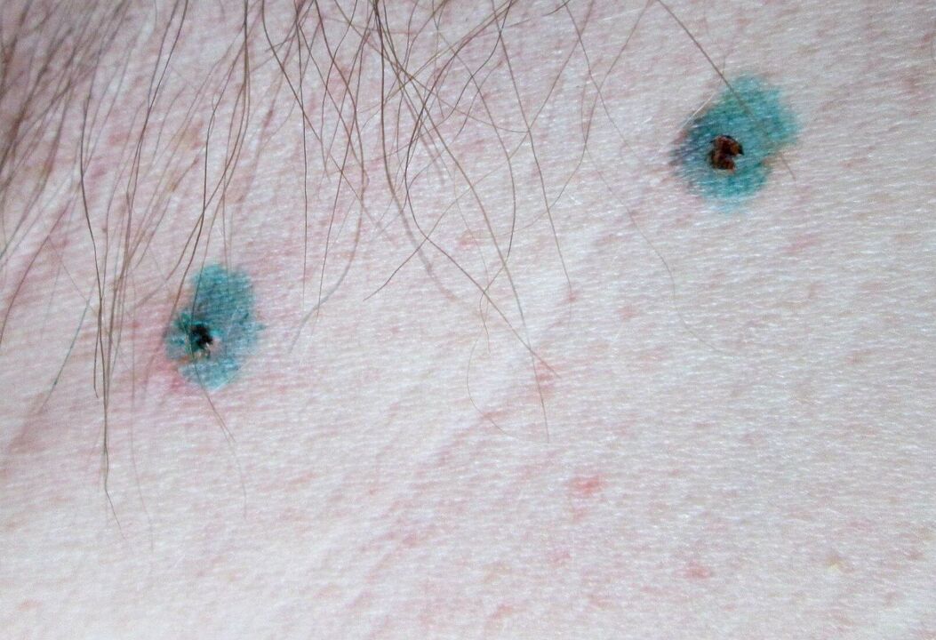 Taches sur la peau après élimination au laser des papillomes